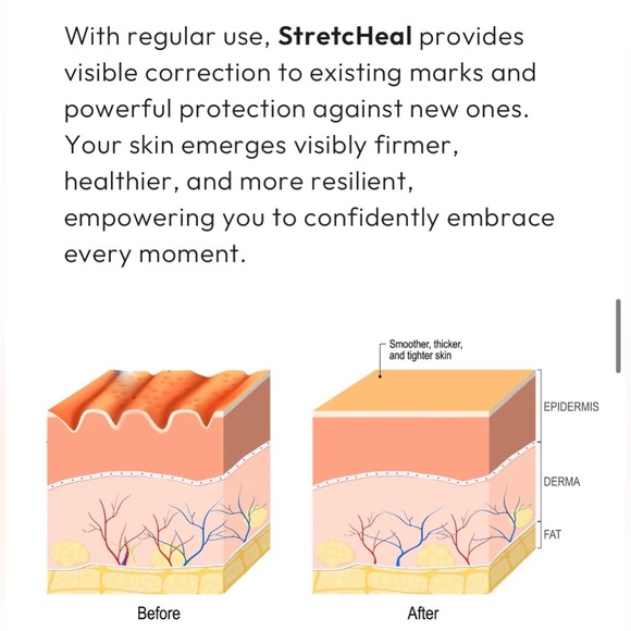 NWT StretcHeal Set Anti Stretch Marks & Scars Cream - Picture 7 of 16